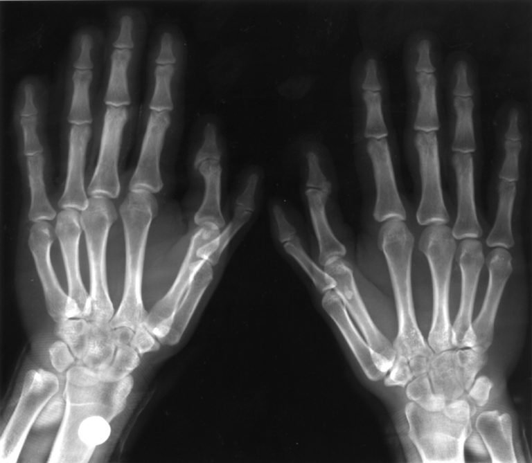 POLYDACTYLY 3 | Buyxraysonline