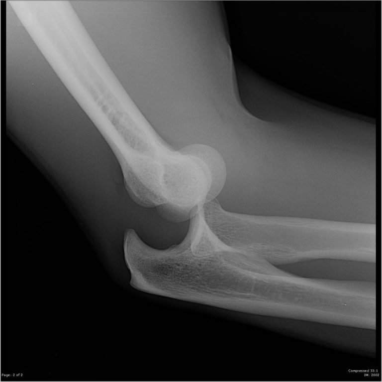 dislocation of elbow x ray