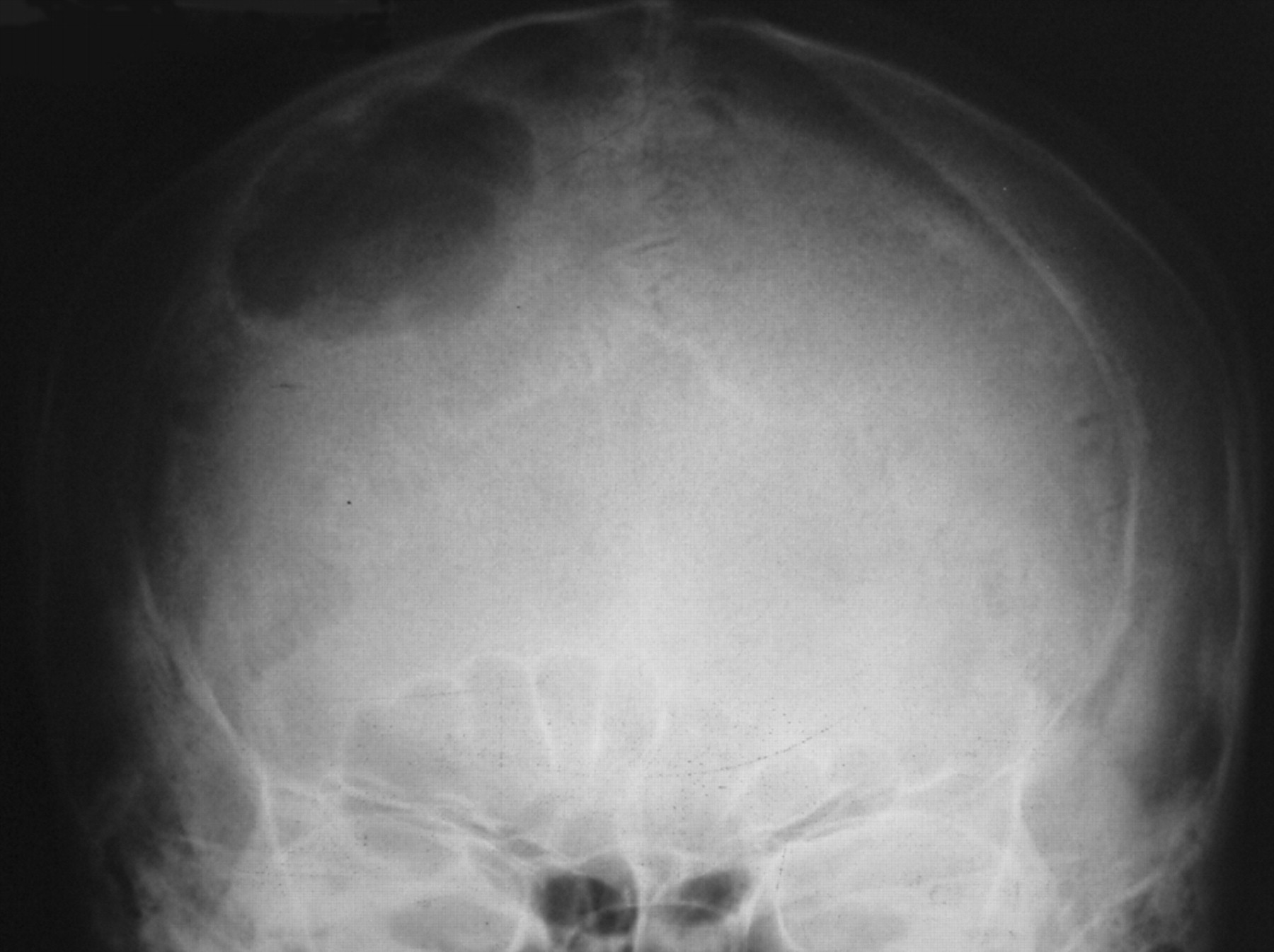 Кости черепа рентген. Менингиома лобной кости. Менингиома рентген черепа.