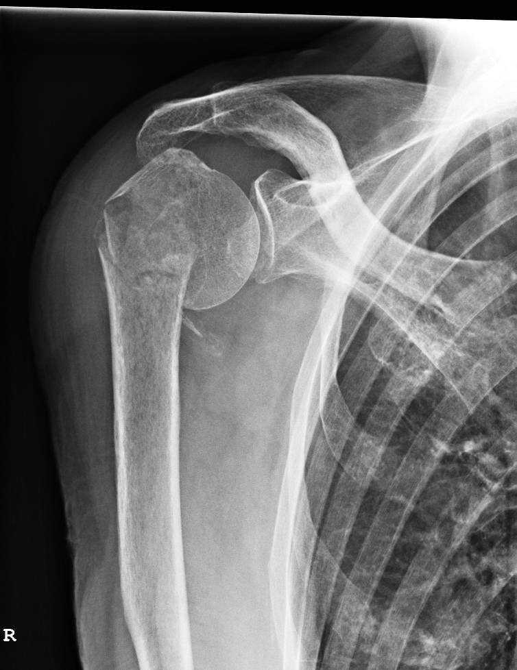 PROXIMAL FRACTURE OF THE HUMERUS Buyxraysonline