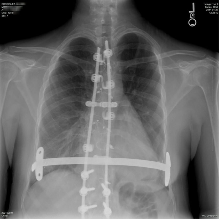 SCOLIOSIS SPINAL FUSION AND MY PECTUS EXCAVATUM REPAIR | Buyxraysonline