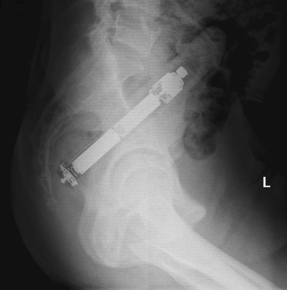 Рентгеновский снимок сломанного члена