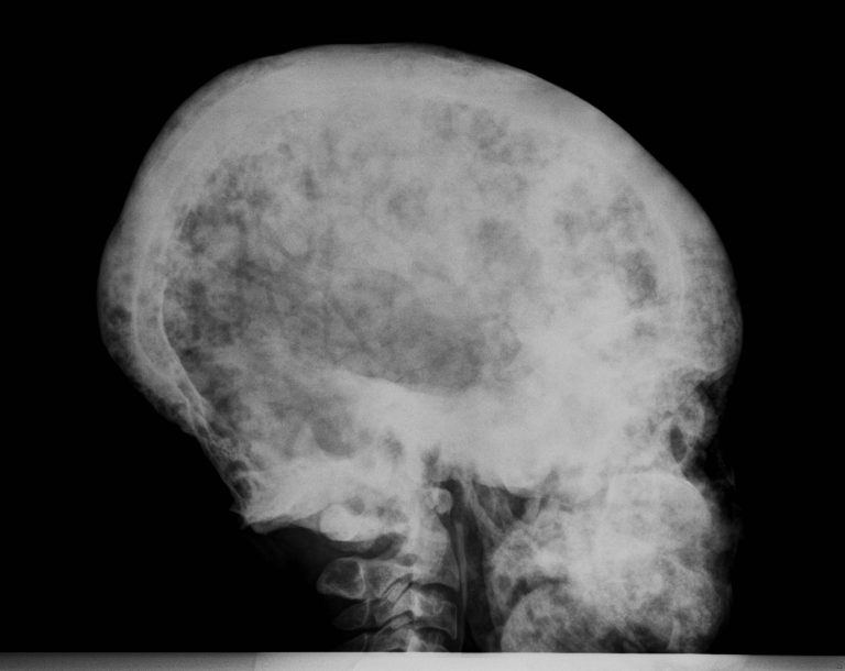 skull-deformity-4-buyxraysonline