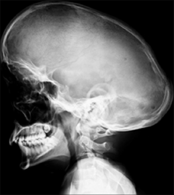 SKULL DEFORMITY Buyxraysonline