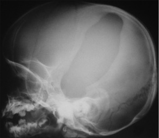 Anterior Skull Fracture