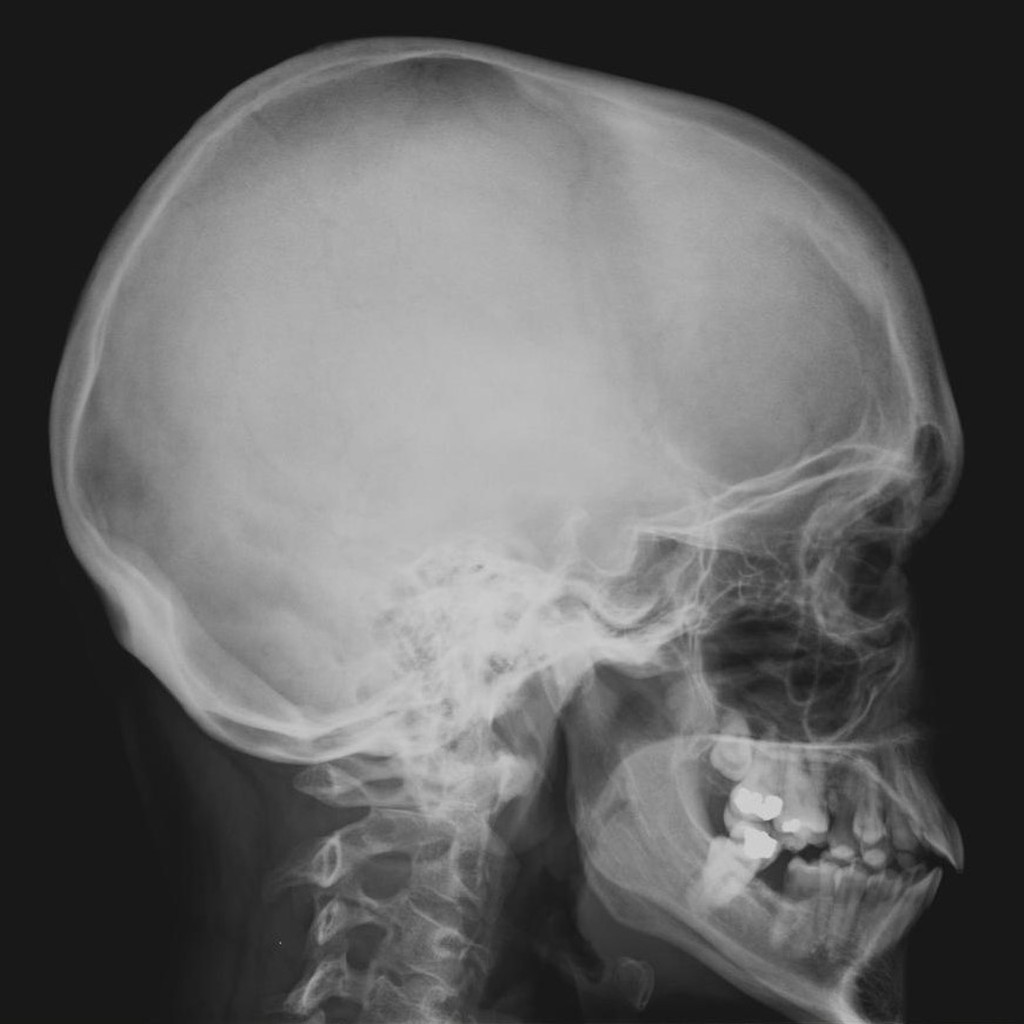 Human Skull Anatomy Lateral View