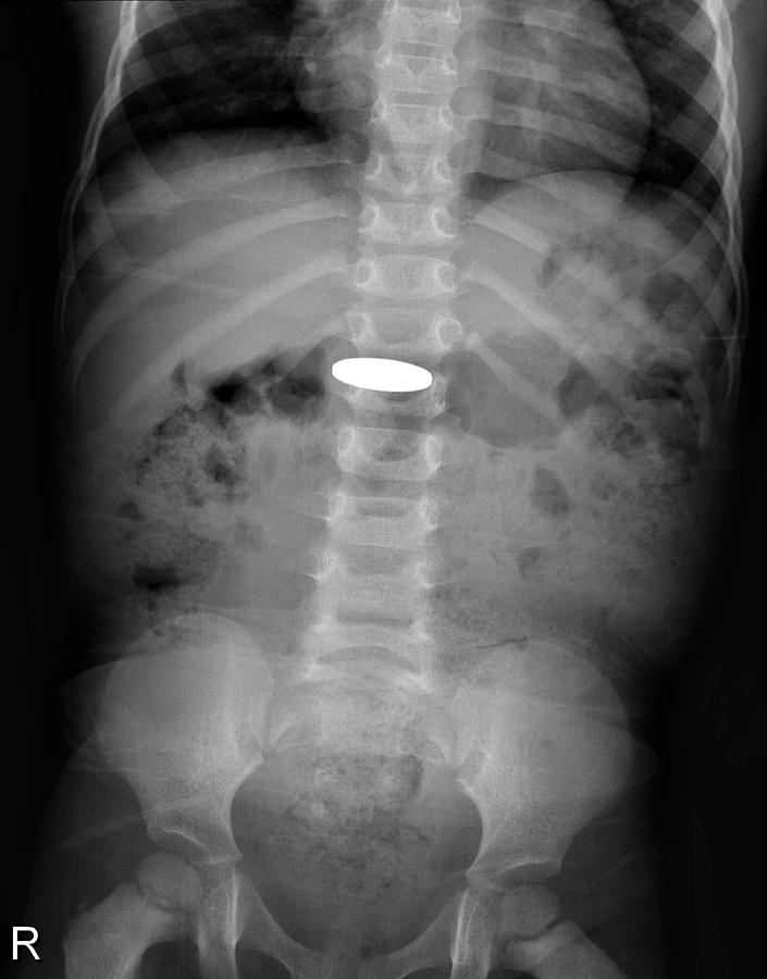 Swallowed Coin Buyxraysonline
