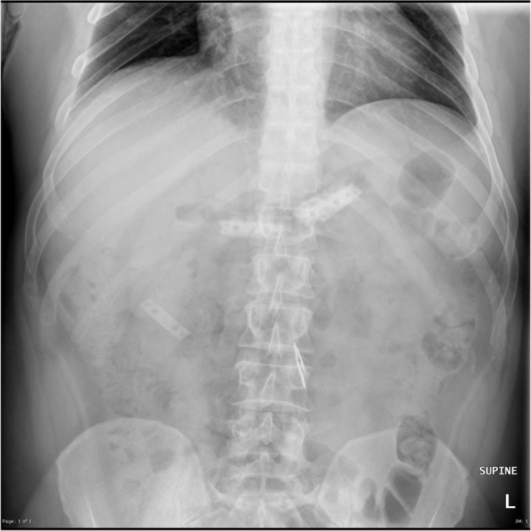 SWALLOWED RAZOR BLADES