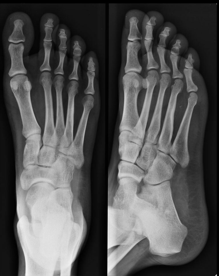 SWELLING FOOT | Buyxraysonline