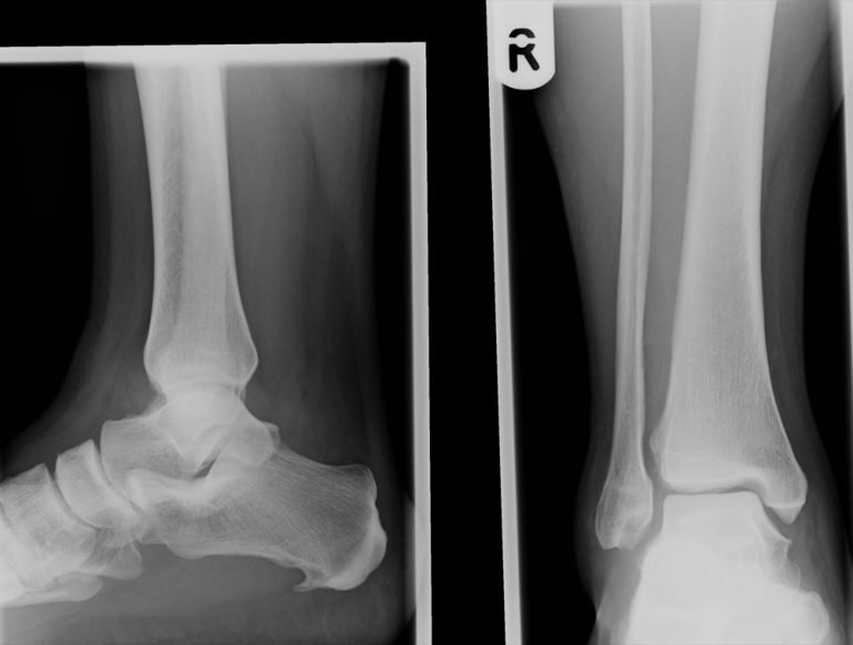 WIDE SYNDESMOSIS | Buyxraysonline