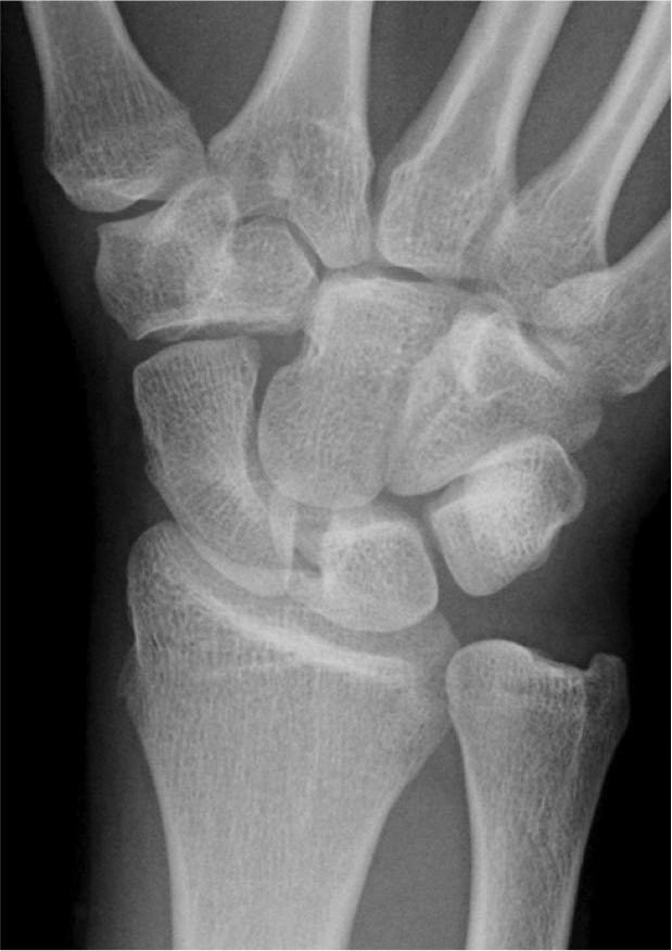 Lateral Wrist X Ray Labeled