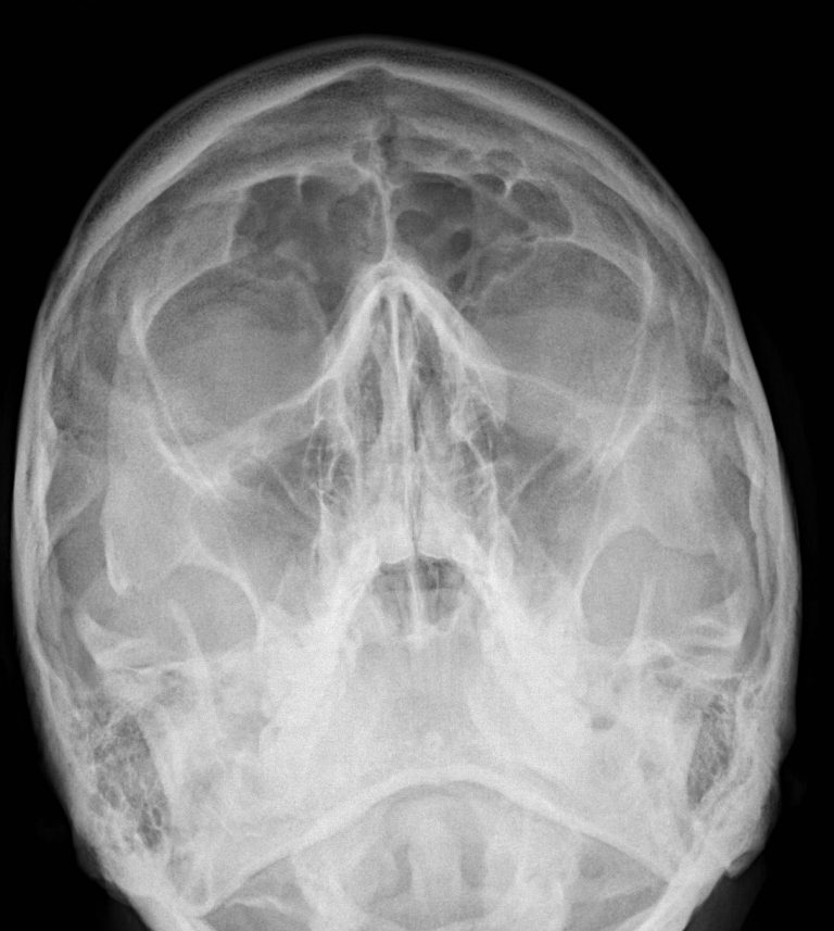 closed fracture of zygomatic arch