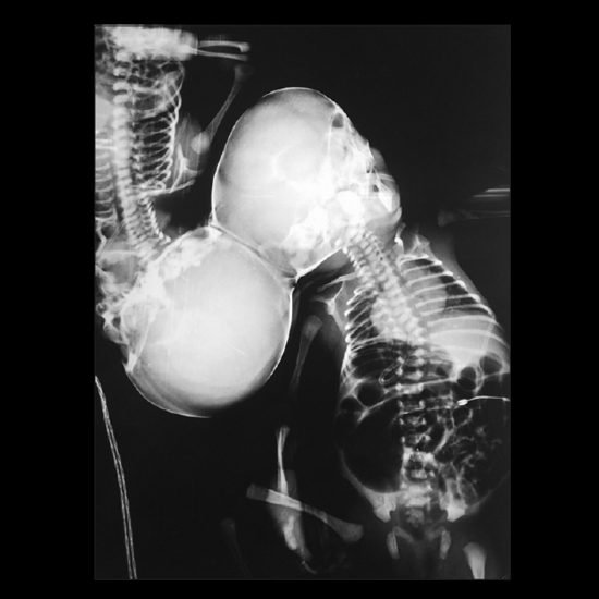 CRANIOPAGUS TWINS Buyxraysonline CRANIOPAGUS TWINS Buyxraysonline